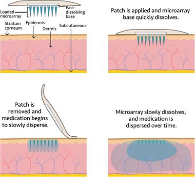 Microarray patch for HIV prevention and as a multipurpose prevention technology to prevent HIV and unplanned pregnancy: an assessment of potential acceptability, usability, and programmatic fit in Kenya